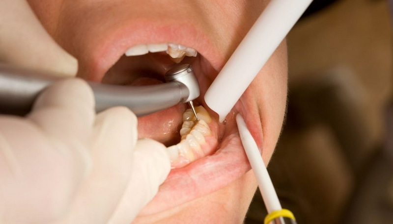 Răng lấy tủy rồi vẫn đau nguy hiểm không? Khi nào đáng lo? Người bệnh cần đến nha khoa để bác sĩ điều trị chuyên sâu