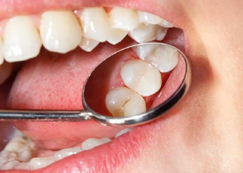 Răng sâu nặng có bọc sứ được không? Điều kiện giữ lại răng thật Điều trị răng sâu sớm để tăng khả năng giữ lại răng thật