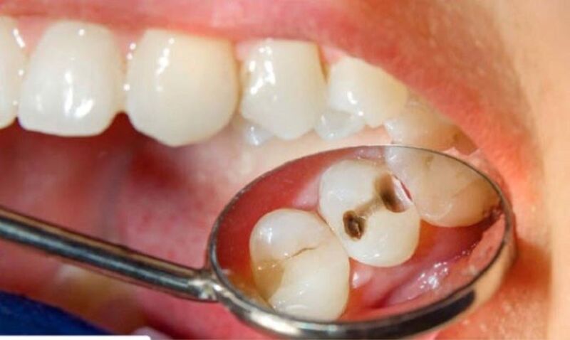Răng sâu nặng có bọc sứ được không? Điều kiện giữ lại răng thật Răng sâu mất mô lớn cần bọc sứ để bảo vệ thân răng