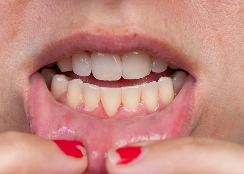 Tụt lợi có nên bọc răng sứ không? Khi nào nên và không nên bọc Trường hợp tụt lợi nhẹ vẫn có thể bọc răng sứ để cải thiện thẩm mỹ