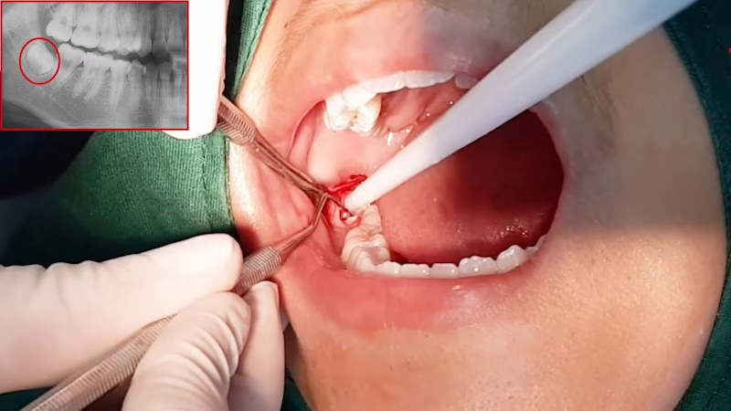 17 tuổi nhổ răng có mọc lại không? Trường hợp nào có thể mọc lại Nhổ răng vĩnh viễn sẽ không thể mọc lại