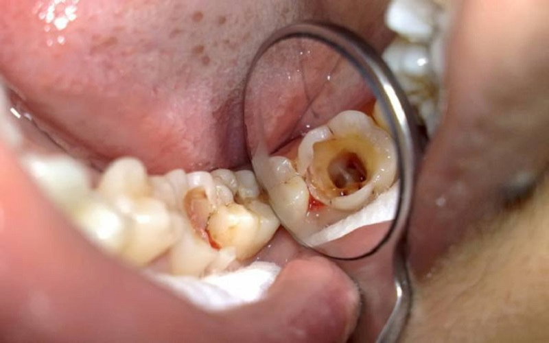 17 tuổi nhổ răng có mọc lại không? Trường hợp nào có thể mọc lại Nếu răng đang viêm nặng thì cần thăm khám nha khoa trước khi nhổ răng