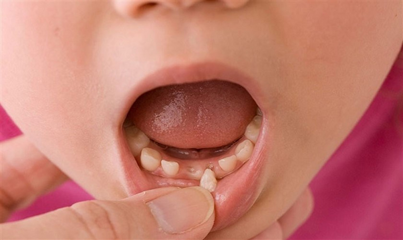 20 tuổi nhổ răng có mọc lại không? Có cần trồng lại không? Nhổ răng sữa ở trẻ em vẫn có thể mọc lại bình thường