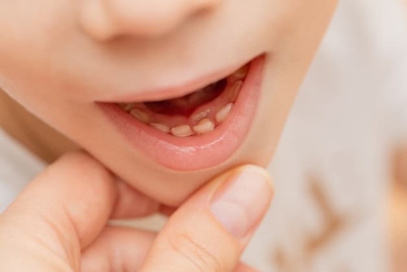 Bé 4 tuổi có nhổ răng được không? Giải đáp ngay Bé 4 tuổi cần cân nhắc kỹ lưỡng khi nhổ răng