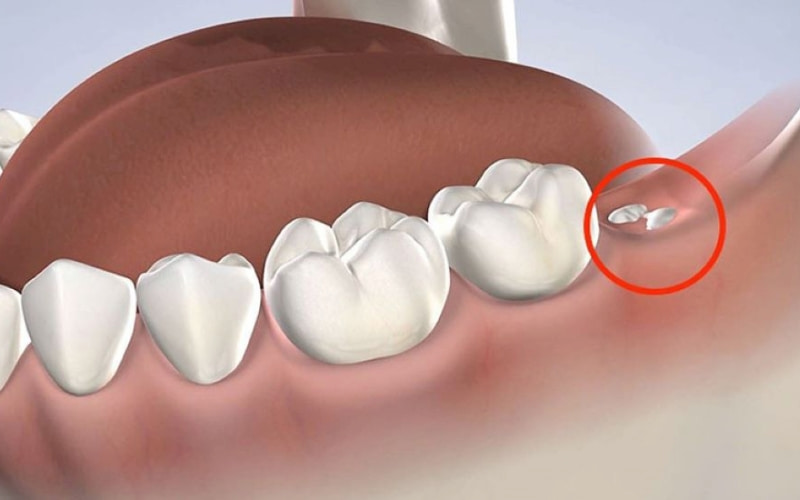 Những biến chứng khi nhổ răng số 8 thường gặp cần lưu ý Sót chân răng là biến chứng có thể xảy ra khi nhổ răng số 8