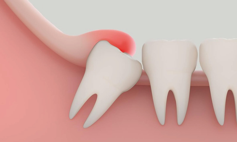 Những biến chứng nhổ răng khôn hàm dưới thường gặp bien chung nho rang khon ham duoi 3