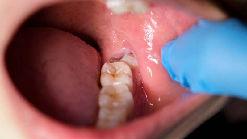 Có nên nhổ răng số 8 không? Khi nào nhổ là tốt nhất Quyết định nhổ răng số 8 tùy thuộc vào từng trường hợp cụ thể