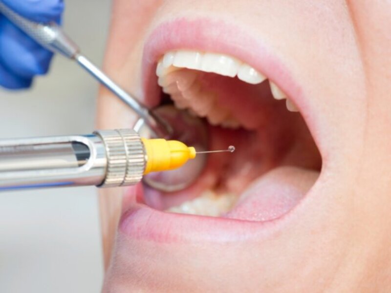 Dị ứng thuốc tê nhổ răng nguy hiểm không? Dấu hiệu & cách xử lý Dị ứng thuốc tê nhổ răng là tình huống hiếm gặp trong nha khoa