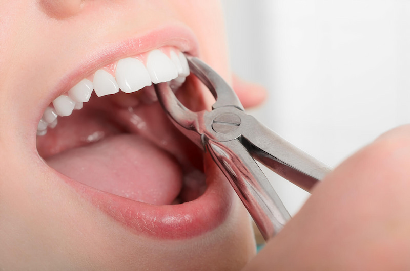 Tất tần tật về dụng cụ nhổ răng trong nha khoa Dụng cụ nhổ răng quyết định đến hiệu quả và độ an toàn khi nhổ răng