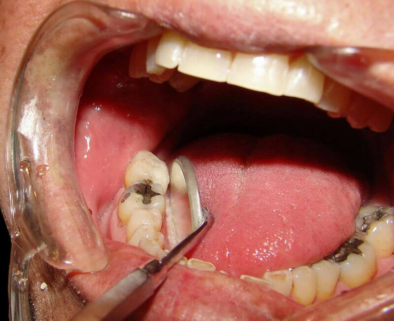 Giá nhổ răng hàm bị sâu bao nhiêu? Khi nào phải trả phí cao hơn? Với trường hợp răng nằm sâu trong xương thì chi phí nhổ sẽ cao hơn bình thường