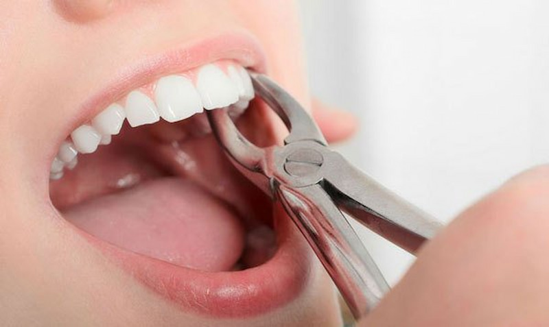 Các loại kìm nhổ răng phổ biến sử dụng trong nha khoa Kìm nhổ răng là thiết bị chuyên dụng trong nha khoa