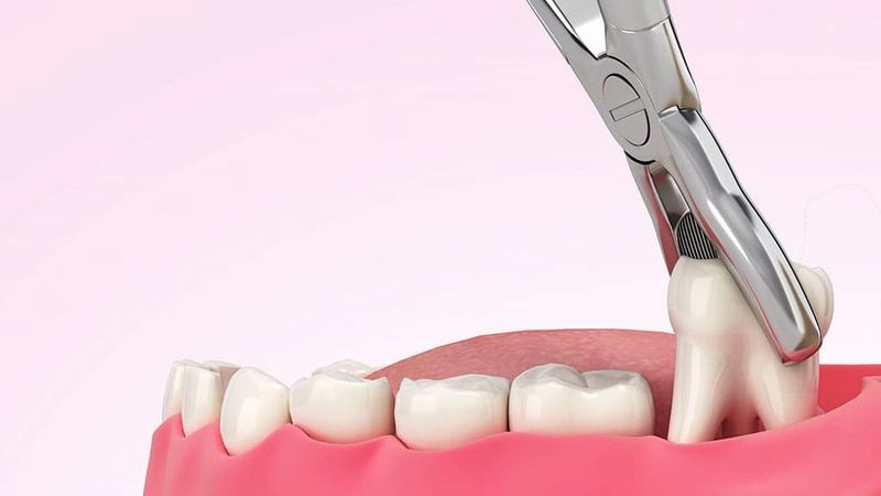 Các loại kìm nhổ răng phổ biến sử dụng trong nha khoa Kìm nhổ răng được làm từ thép không gỉ, có độ bền cao