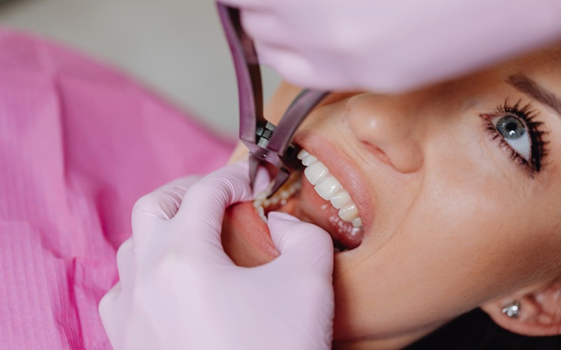 Các loại kìm nhổ răng phổ biến sử dụng trong nha khoa Dùng kìm nhổ răng đúng loại giúp hạn chế biến chứng