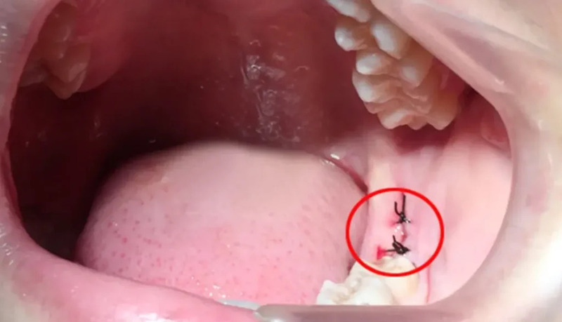 Lỗ sau khi nhổ răng khôn có bình thường không? Giải đáp ngay Ổ răng sau nhổ răng khôn vẫn còn lỗ hở nhẹ là bình thường