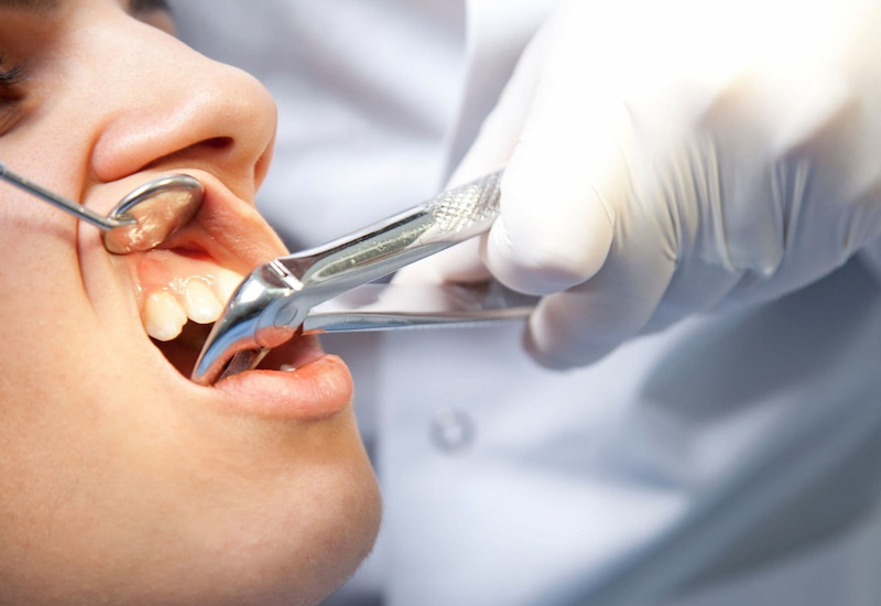 Nên nhổ răng khôn ở bệnh viện hay phòng khám? Nên nhổ răng khôn ở bệnh viện hay phòng khám