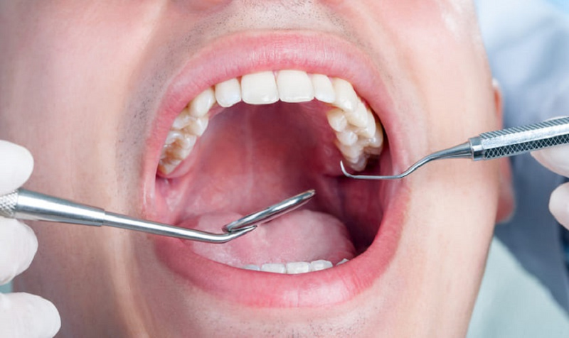 Nhổ răng hàm trên có nguy hiểm không? Lưu ý tránh biến chứng Nhổ răng hàm trên có nguy hiểm không? Nhổ răng hàm trên không nguy hiểm khi được thực hiện đúng quy trình chuyên môn