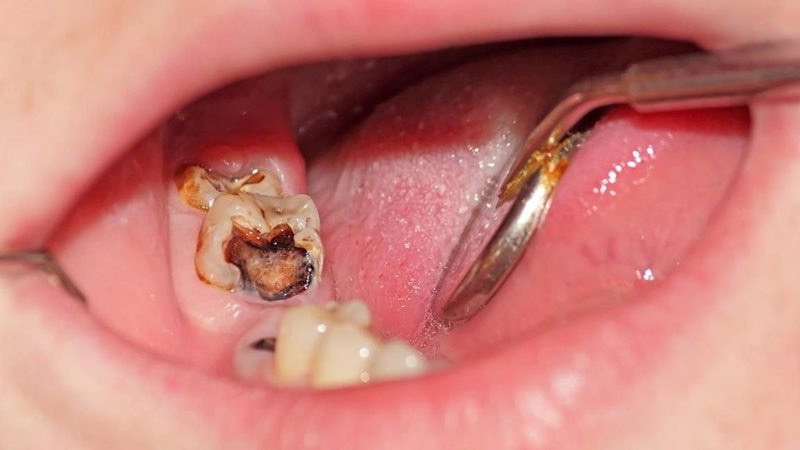 Nhổ răng hàm trên có nguy hiểm không? Lưu ý tránh biến chứng Nhổ răng hàm dưới được đánh giá cao về tính an toàn