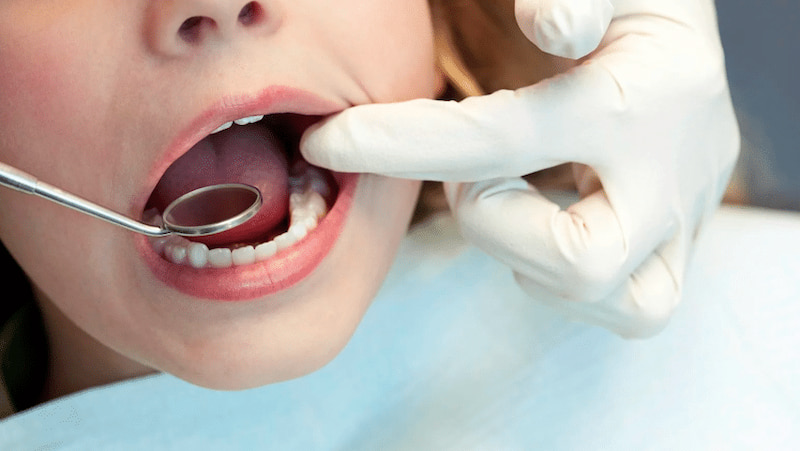 Nhổ răng khôn có đau không? Trường hợp nào đau nhiều? Can thiệp răng hàm dưới sẽ khó và đau hơn