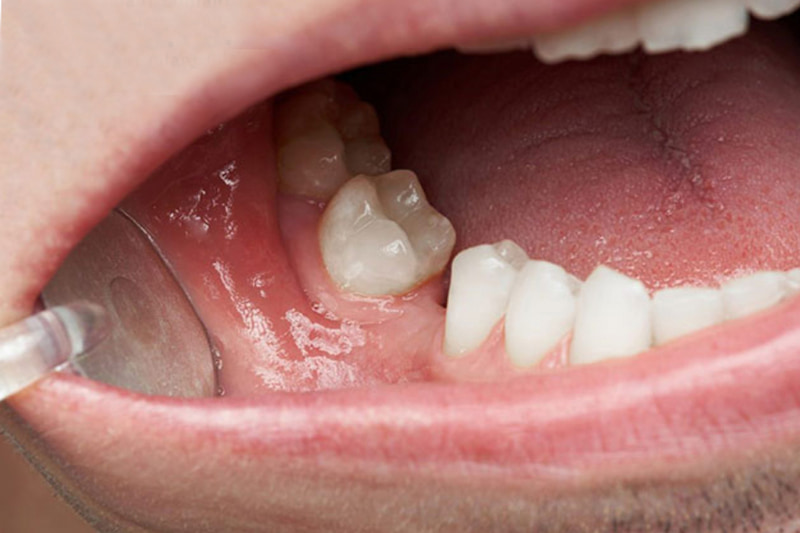 Nhổ răng không trồng lại có sao không và ai phải trồng sớm? Nhổ răng không trồng lại có sao không? Câu trả lời là có