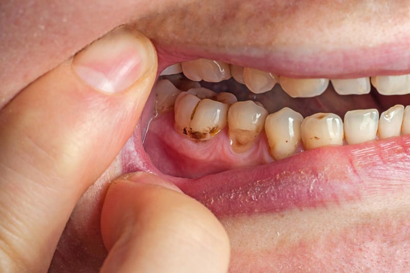 Nhổ răng không trồng lại có sao không và ai phải trồng sớm? Khoảng trống sau khi nhổ răng khó làm sạch dễ sâu răng, viêm nha chu,...