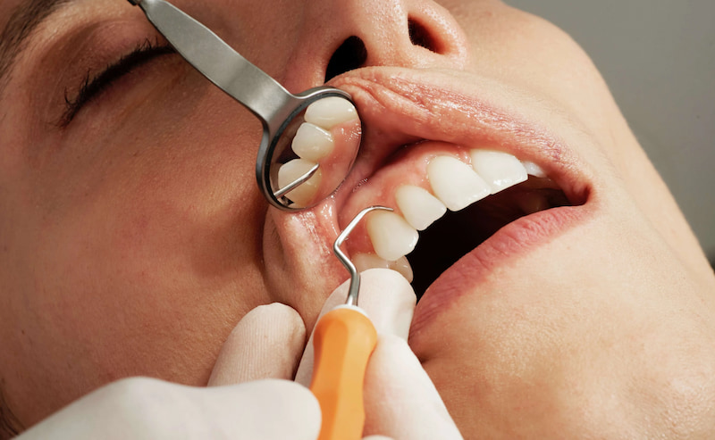 Nhổ răng không trồng lại có sao không và ai phải trồng sớm? Nhổ răng cửa cần chờ từ 1-3 tháng mới trồng để nướu và xương hàm ổn định