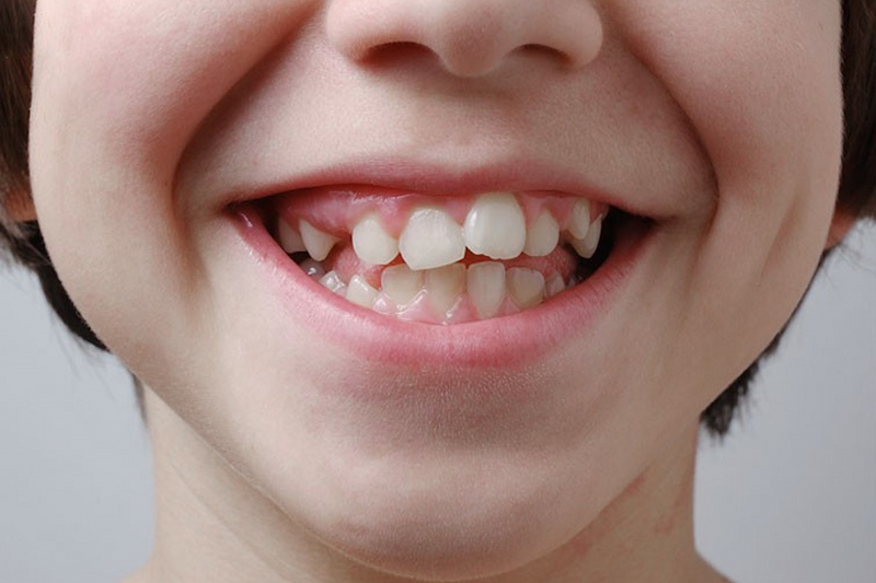 Nhổ răng sữa bao nhiêu tiền? Yếu tố ảnh hưởng đến chi phí Khi răng sữa chưa lung lay thì không cần nhổ
