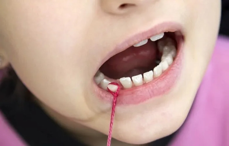 Nhổ răng sữa bao nhiêu tiền? Yếu tố ảnh hưởng đến chi phí Cha mẹ không nên tự nhổ răng sữa cho trẻ tại nhà