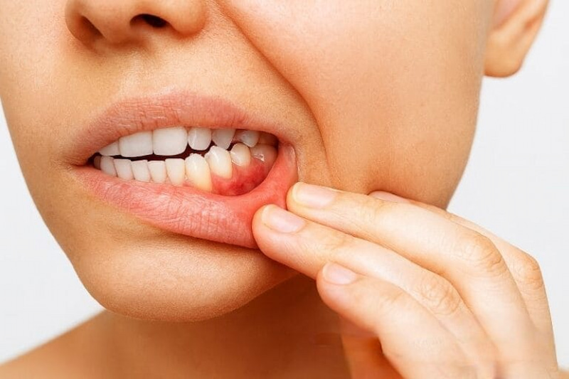 Nhổ răng số 7 giá bao nhiêu? Khi nào giá cao hơn bình thường? Trường hợp có viêm quanh răng thì chi phí nhổ sẽ cao hơn bình thường