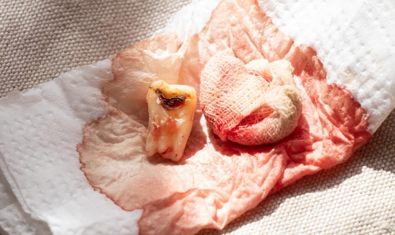 Nhổ răng số 7 hàm trên có nguy hiểm không? Khi nào nên nhổ? Nếu vị trí nhổ răng chảy máu kéo dài thì nên thăm khám bác sĩ ngay