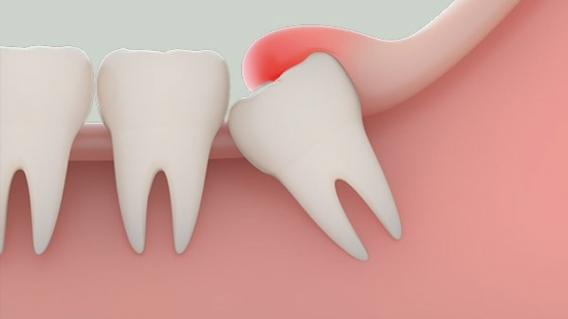 Nhổ răng số 8 bao nhiêu tiền? Các yếu tố ảnh hưởng đến gia· Chi phí nhổ răng số 8 có sự chênh lệch khá lớn