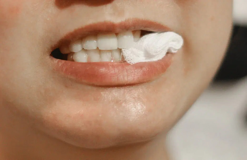 Quy trình nhổ răng khôn chi tiết và những lưu ý quan trọng Cắn chặt bông gạc 30 phút đến 1 giờ đầu để tạo cục máu đông và cầm máu