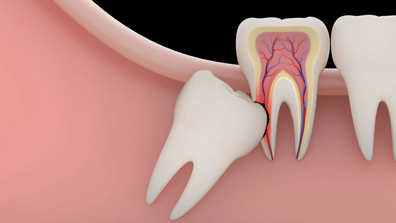Răng khôn mọc lệch nhưng không đau có nên nhổ - Bác sĩ đáp Phần lớn các trường hợp răng khôn mọc lệch nhưng không đau vẫn nên nhổ bỏ
