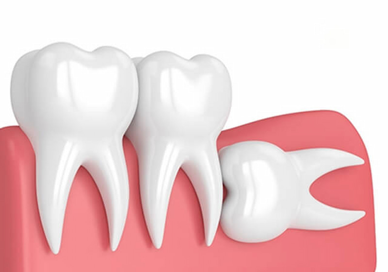 Răng khôn mọc lệch nhưng không đau có nên nhổ - Bác sĩ đáp Trường hợp răng khôn mọc ngược nên nhổ sớm