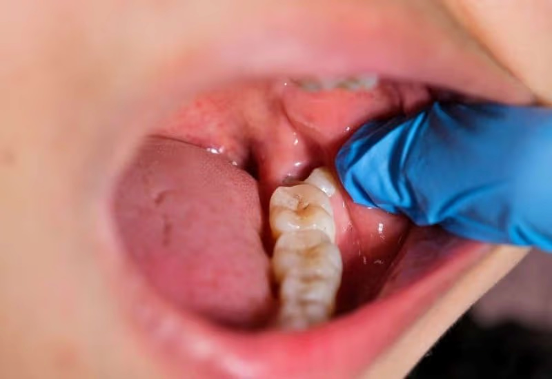 Răng khôn nhổ rồi có mọc lại không? Lưu ý tránh biến chứng Răng khôn nhổ bỏ không ảnh hưởng đến chức năng ăn nhai nên không cần trồng lại