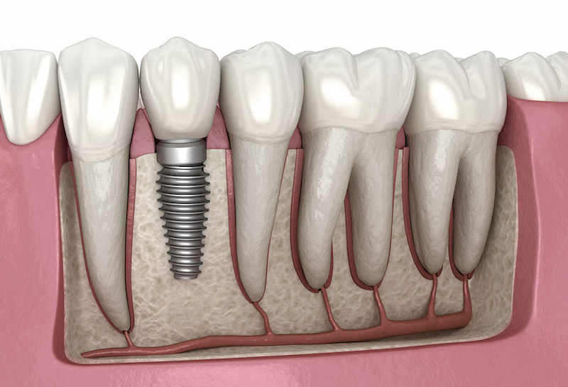 Bác sĩ giải đáp sau khi nhổ răng bao lâu thì trồng Implant? Trồng răng Implant khoảng 2-3 tháng sau khi nhổ răng là thời điểm lý tưởng