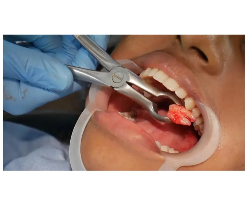 Sau khi nhổ răng mấy tiếng thì được ăn? Nên ăn gì? Thông thường sau nhổ răng khoảng 2–6 tiếng rồi mới ăn