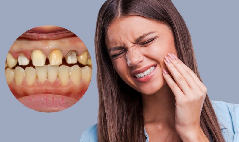 Bọc mão răng sứ có đau không? Cách giảm đau, đảm bảo an toàn Cảm giác đau sau bọc mão răng sứ thường kéo dài khoảng 2 - 3 ngày
