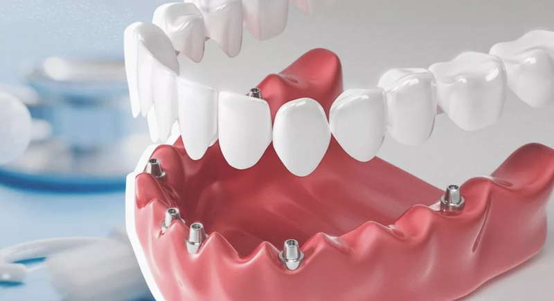 Bọc mão răng sứ giá bao nhiêu? Lưu ý để tránh tốn tiền oan Trường hợp phục hình Implant có thể bọc mão răng sứ