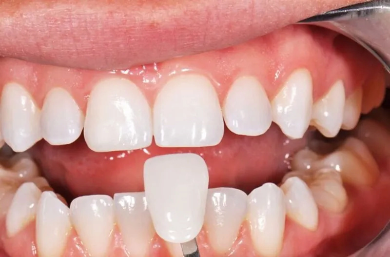 Bọc mão răng sứ giá bao nhiêu? Lưu ý để tránh tốn tiền oan Bạn cần tìm hiểu rõ về chất lượng răng sứ trước khi quyết định thực hiện để tránh mất tiền oan