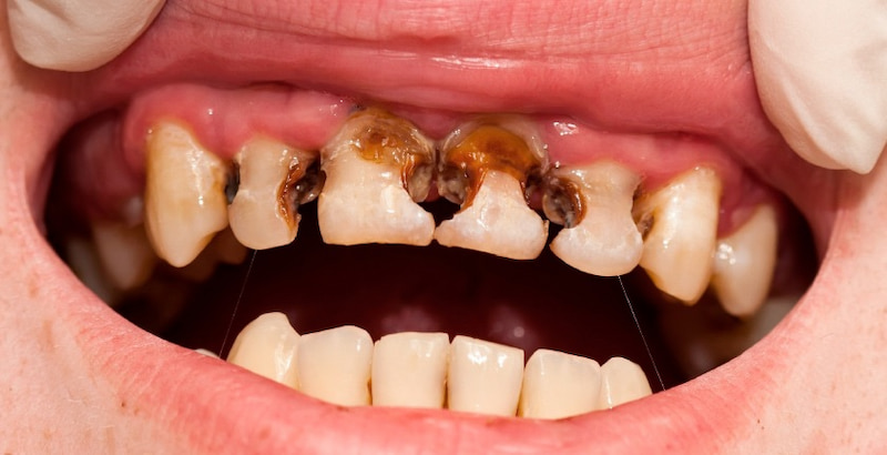 Bọc răng sứ có cần nhổ răng không? Trường hợp cần nhổ răng Khi răng sâu đã phá hủy toàn bộ thân răng thì bác sĩ sẽ chỉ định nhổ khi bọc sứ