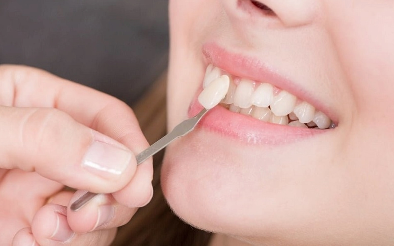 Bọc răng sứ có cần nhổ răng không? Trường hợp cần nhổ răng Chọn mão sứ chất lượng để đảm bảo chức năng ăn nhai