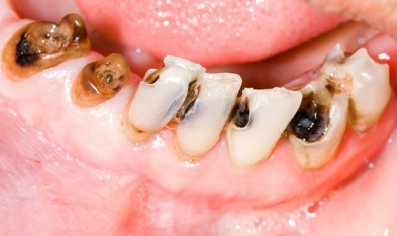 Bọc sứ răng sâu bao nhiêu tiền? Yếu tố quyết định mức giá Trường hợp răng sâu lớn có thể bọc sứ để cải thiện