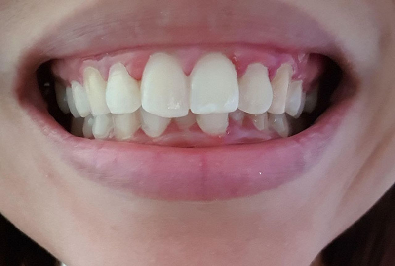 Chỉnh răng hô không cần niềng có được không? Phương pháp hiệu quả Hô nhẹ do hình thể có thể chỉnh răng hô mà không cần niềng