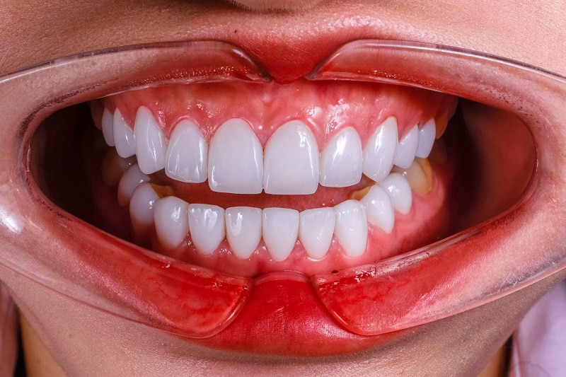 Chỉnh răng hô không cần niềng có được không? Phương pháp hiệu quả Dán sứ Veneer giúp cải thiện tình trạng răng chìa nhẹ mà không cần niềng