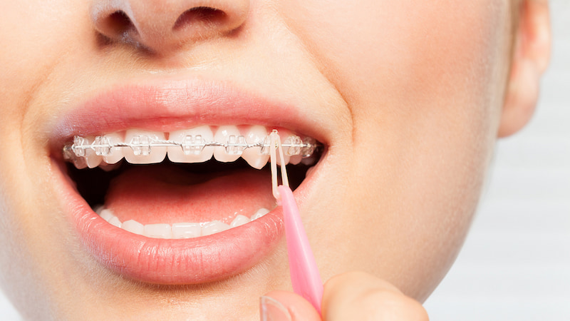Chun chuỗi là gì? Tác dụng và lưu ý khi dùng chun chuỗi Sau khi nhổ răng chỉnh nha bác sĩ sẽ sử dụng chun chuỗi để kéo các răng lại gần nhau