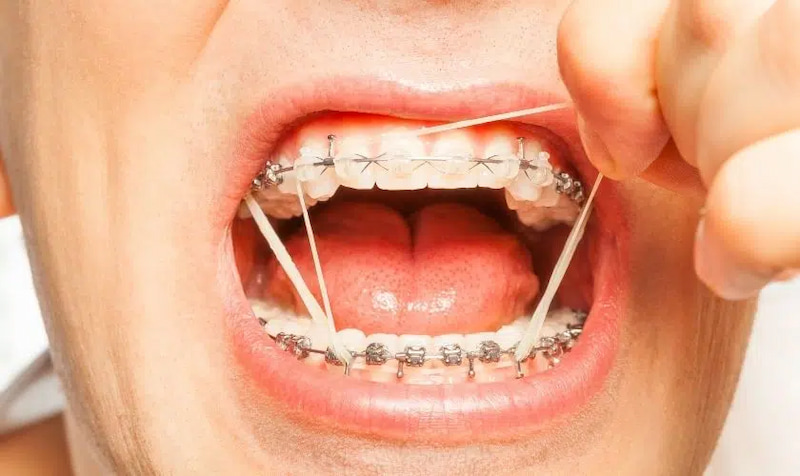 Chun chuỗi là gì? Tác dụng và lưu ý khi dùng chun chuỗi Đeo chun chuỗi cần được thực hiện bởi bác sĩ nha khoa