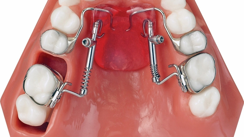 Di xa toàn hàm là gì? Trường hợp nào cần thực hiện Di xa toàn hàm giúp dịch chuyển dịch về đúng vị trí