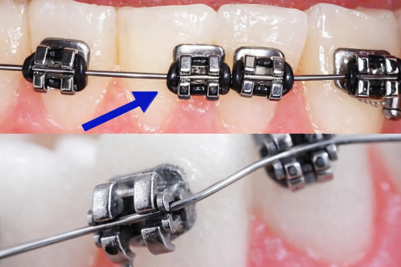 Di xa toàn hàm là gì? Trường hợp nào cần thực hiện Trong nha khoa hiện đại, di xa toàn hàm bằng minivis được đánh giá là phương pháp chỉnh nha hiệu quả