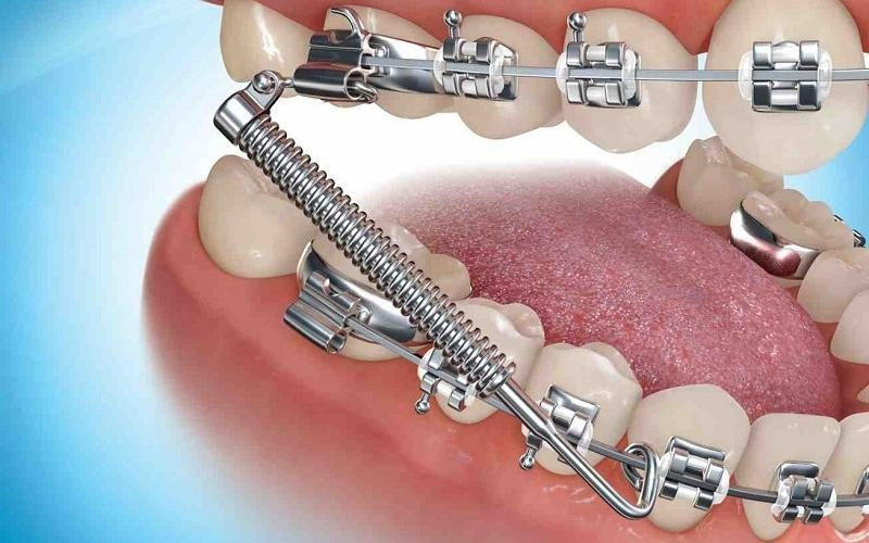 Gắn lò xo khi niềng răng khi nào? Tác dụng và lưu ý Lò xo duy trì giúp giữ ổn định khoảng cách giữa các răng
