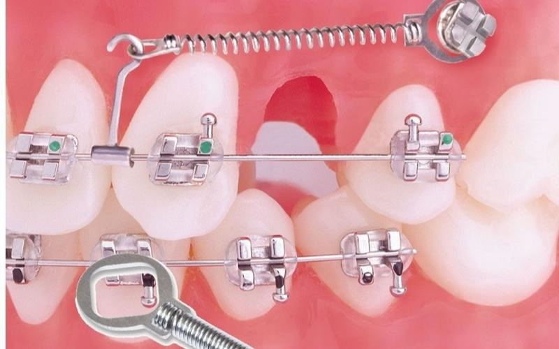 Gắn lò xo khi niềng răng khi nào? Tác dụng và lưu ý Người bệnh tuyệt đối không tự ý tháo lò xo trong khi niềng răng